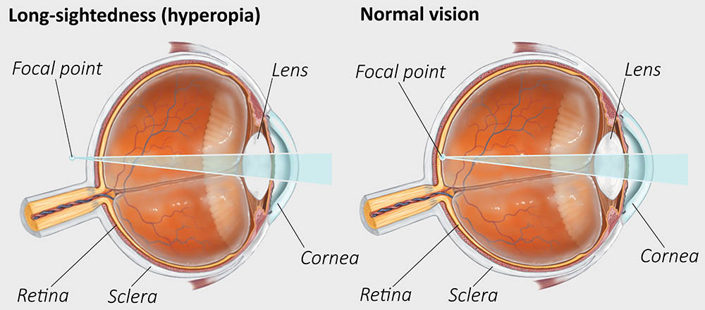 Long sightedness (hypermetropia)